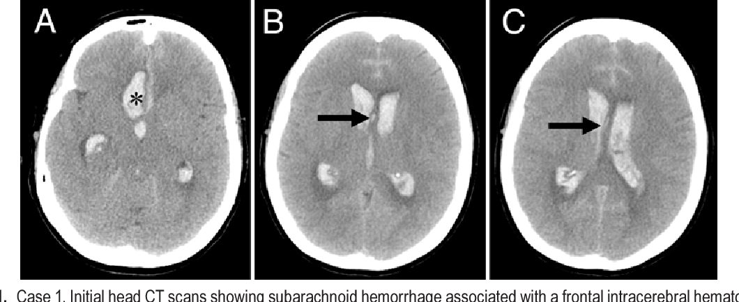 Figure 1 from Rupture of anterior communicating artery aneurysms during ...