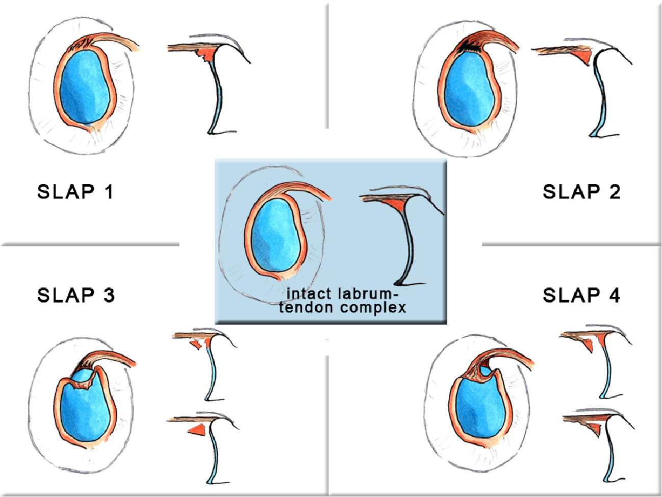 Figure 1 from MR Arthrography: Superior Labral Anterior-Posterior (SLAP ...