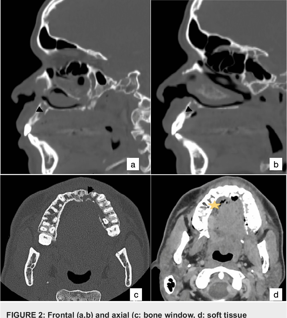 Figure 2 from Acute Myeloid Leukemia Revealed by a Palatal Necrosis: A ...