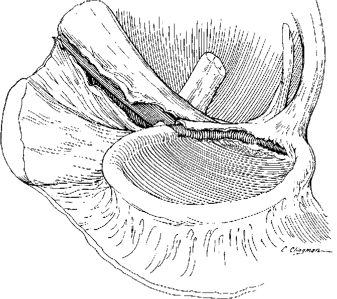 Figure 6 from Superior Labrum-Biceps Tendon Complex Lesions of the ...