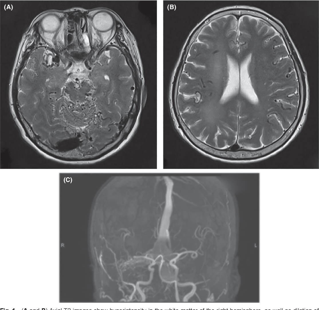 Figure 1 from A Case of Transverse-sigmoid Sinus Dural Arteriovenous ...