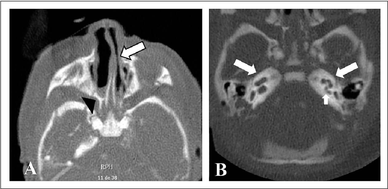 Figure 2 from Phenotypic spectrum of neonatal CHARGE syndrome Espectro ...