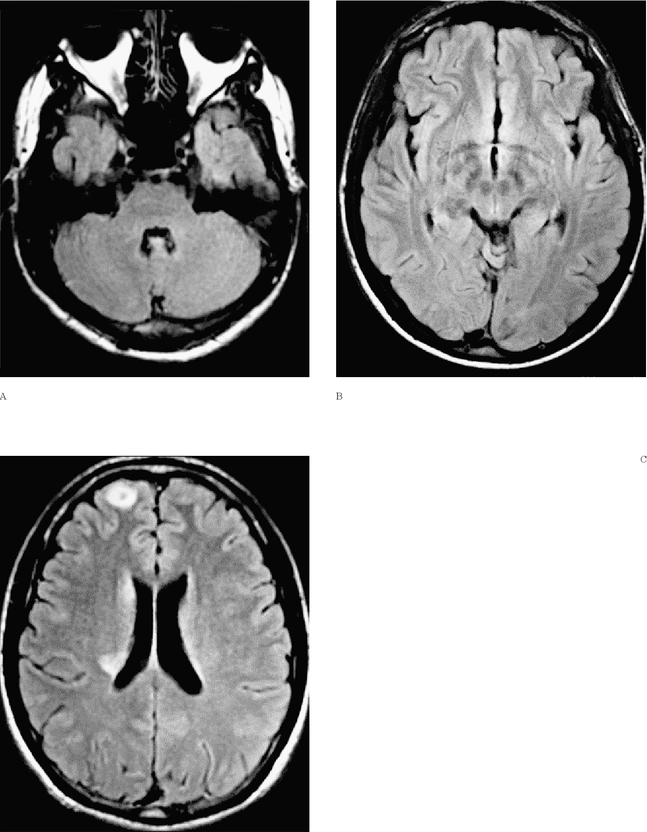 Figure 2 from Transient Brain Lesions in Neuro-Behçet's Disease without ...