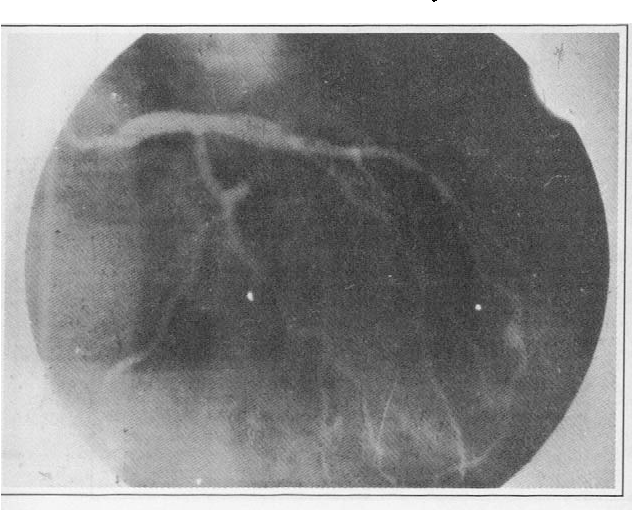 Figure 6 from Coronary Artery Aneurysms | Semantic Scholar