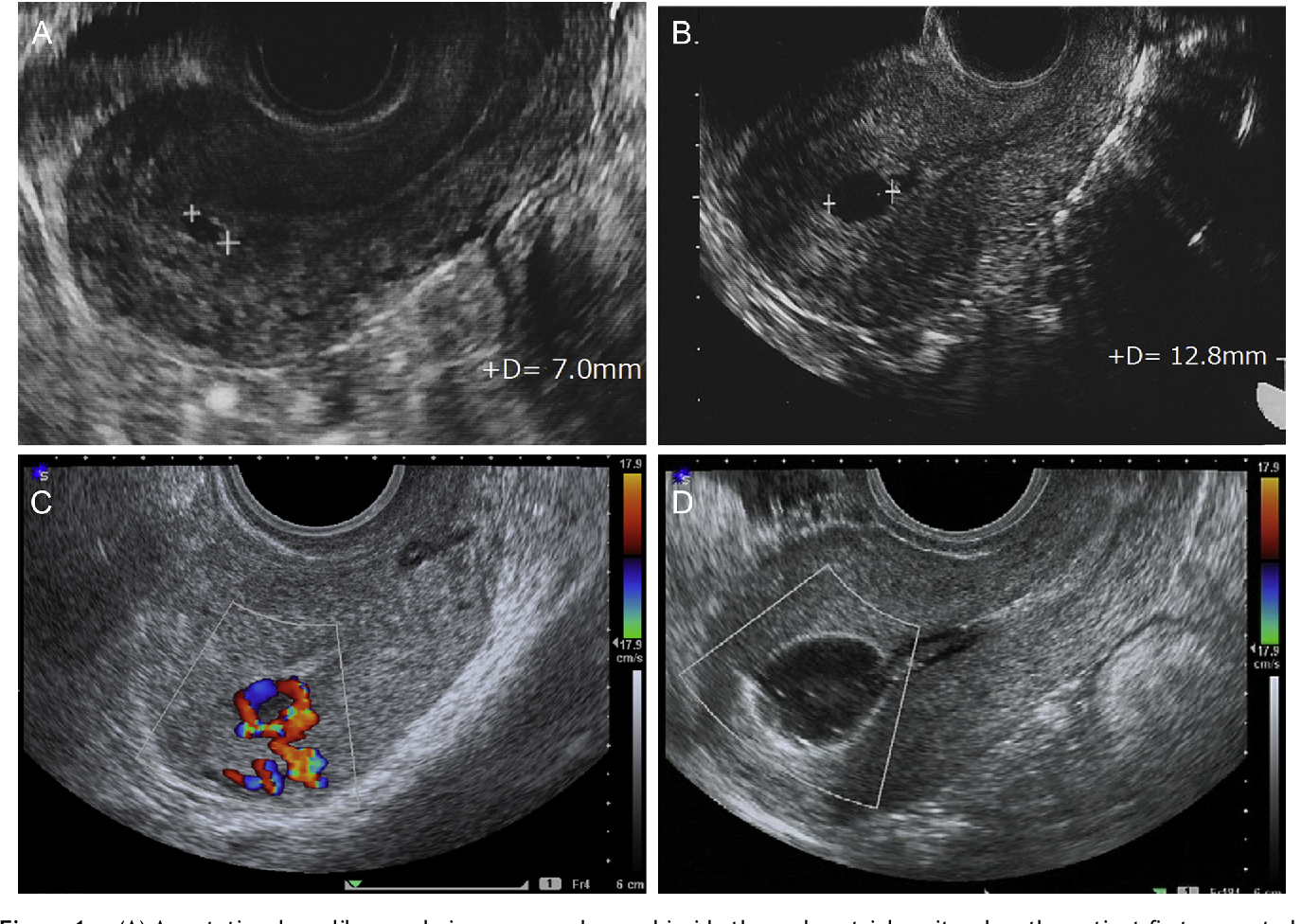 Figure 1 from Use of Intrauterine Balloon Tamponade Test to Determine ...