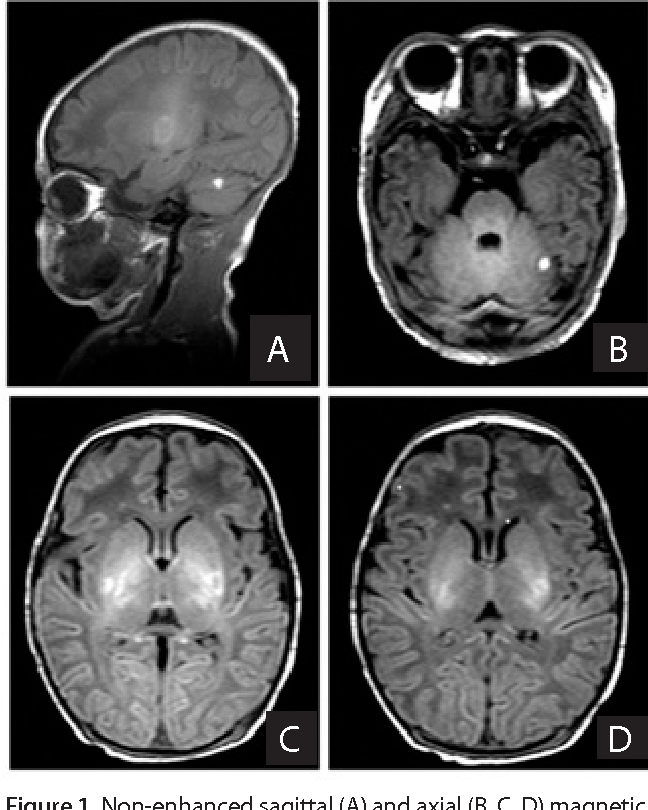 Figure 1 from Chin tremor in full-term neonate after hypoxia | Semantic ...