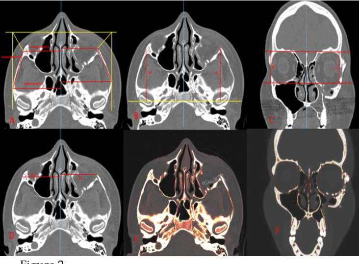 Figure 2 from EVALUATION OF FACIAL ASYMMETRY FOLLOWING ...