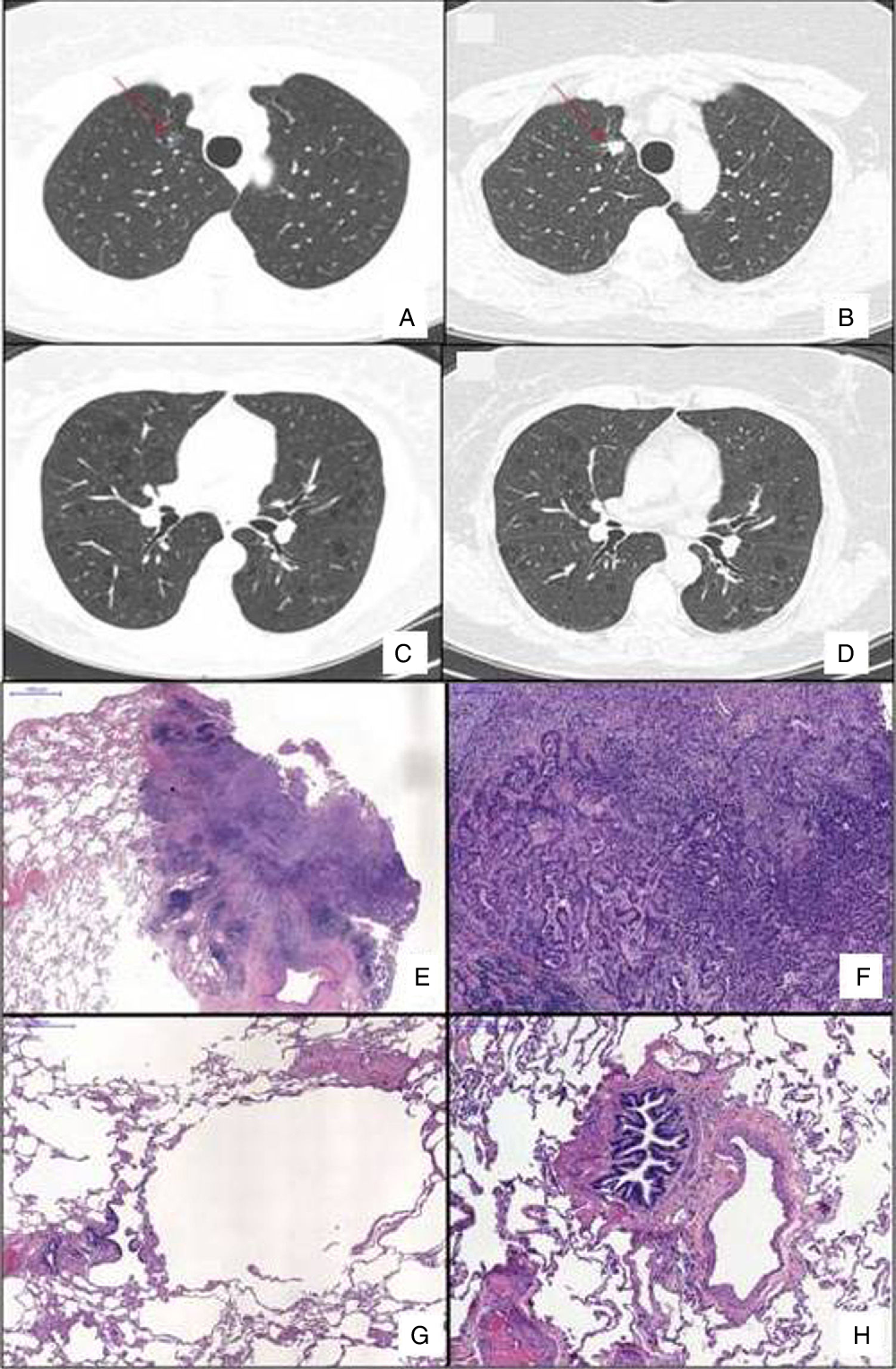 Figure 1 from An Unusual Combination of Diffuse Pulmonary Cysts and a ...