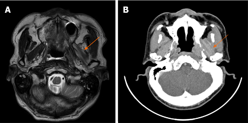 Figure 1 from Various diagnostic possibilities for zygomatic arch pain ...