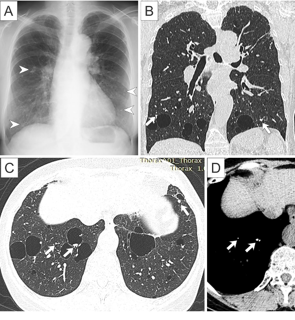 Figure 1 from Nodular Pulmonary Amyloidosis Associated with Sjögren's ...