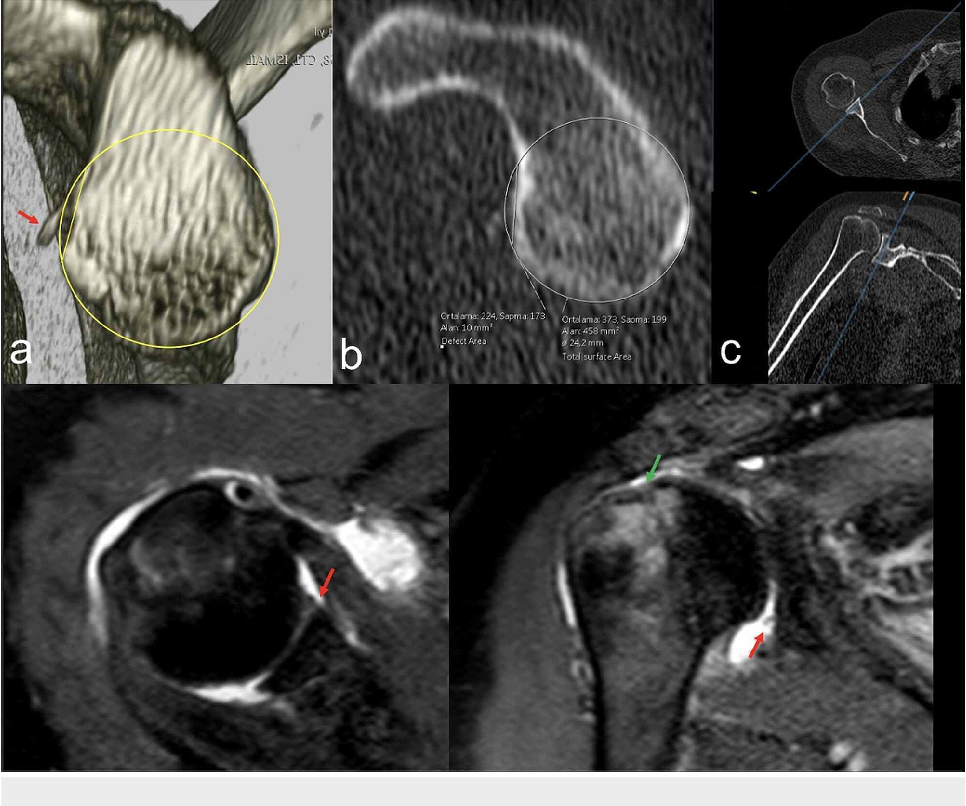 Figure 2 from A Novel Technique for Labral Reconstruction Using Long ...