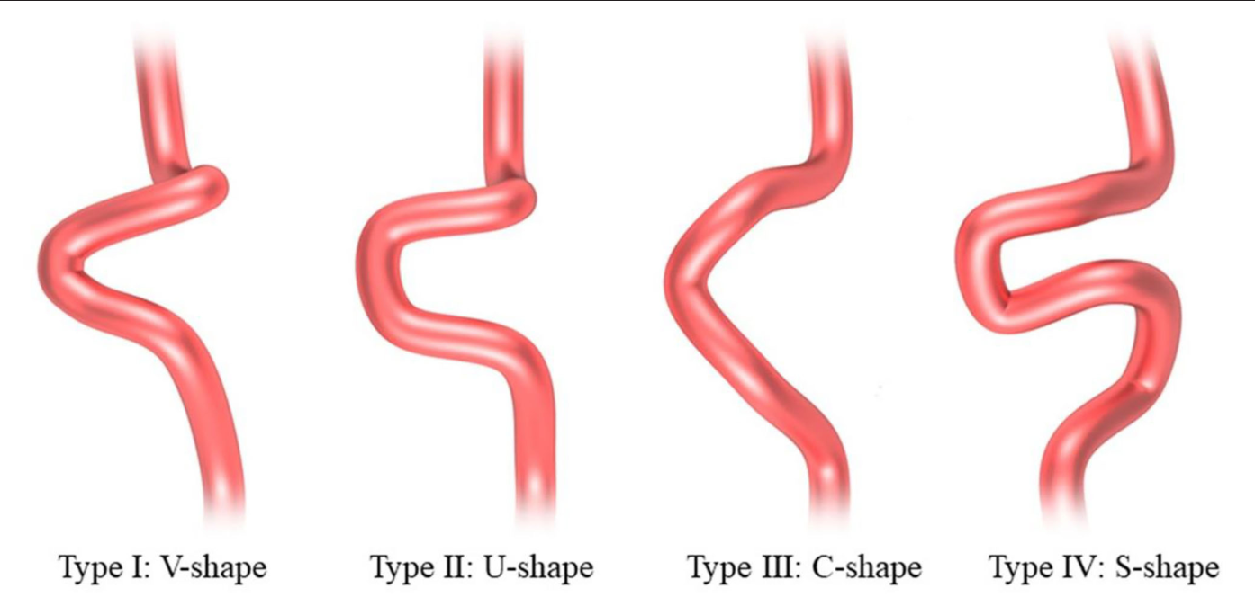 Figure 2 from Increased Carotid Siphon Tortuosity Is a Risk Factor for ...