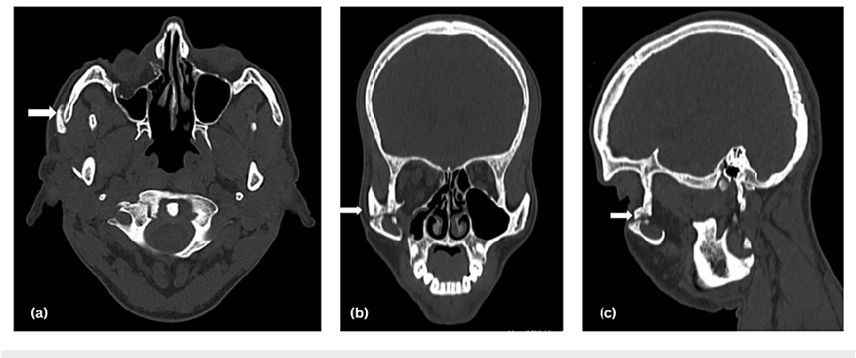 Figure 2 from Management of Ectropion Associated With a Malunited ...