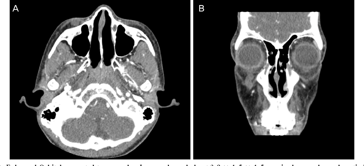 Figure 2 from Solitary Pigmented Plexiform Neurofibroma in Lower Eyelid ...