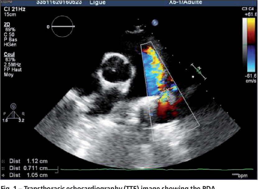 Figure 1 from Patent ductus arteriosus closure using an Amplatzer ... image.