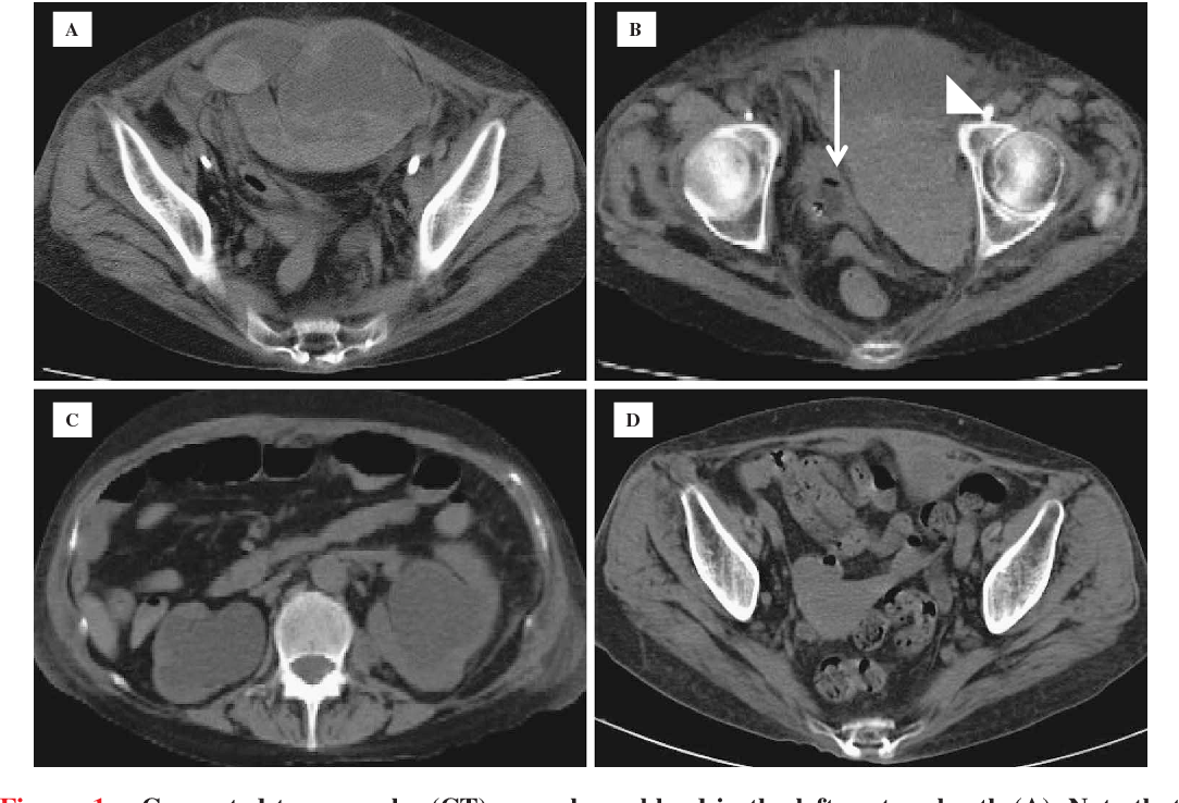 Figure 1 from Hemorrhagic shock and obstructive uropathy due to a large ...