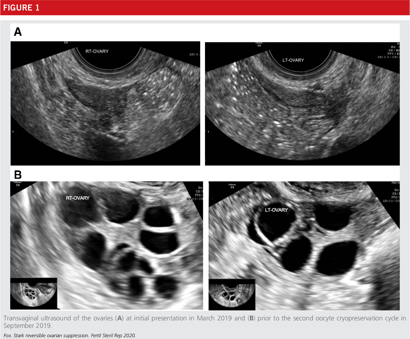 Figure 1 from Evidence of profound ovarian suppression on combined ...