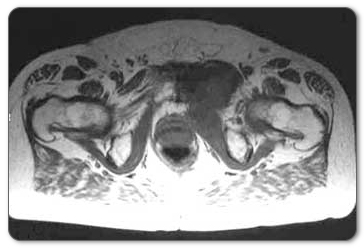 illiopsoas mri