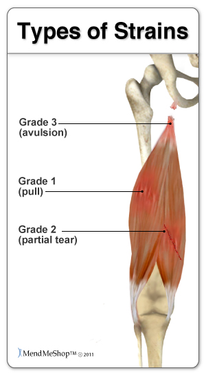 Hip muscle pain can be minor to severe.