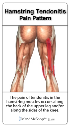 hamstring pain patterns