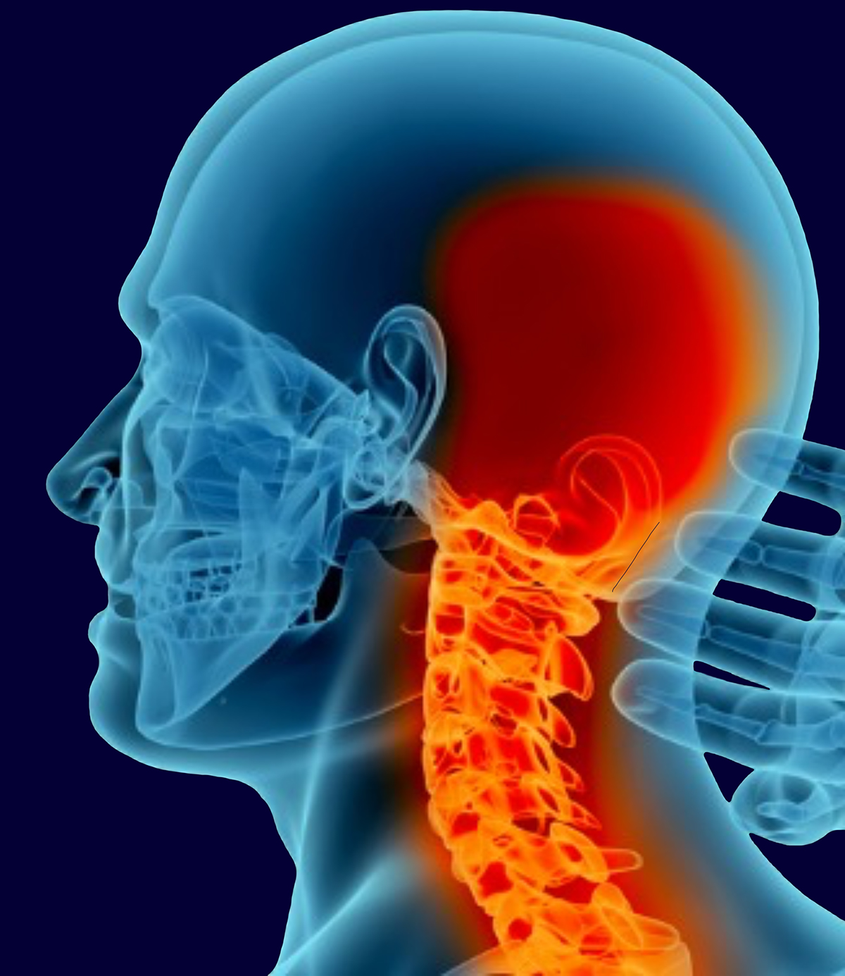 What Is The Treatment For Occipital Neuralgia - vrogue.co