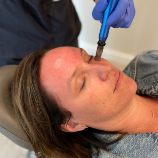 Microneedling