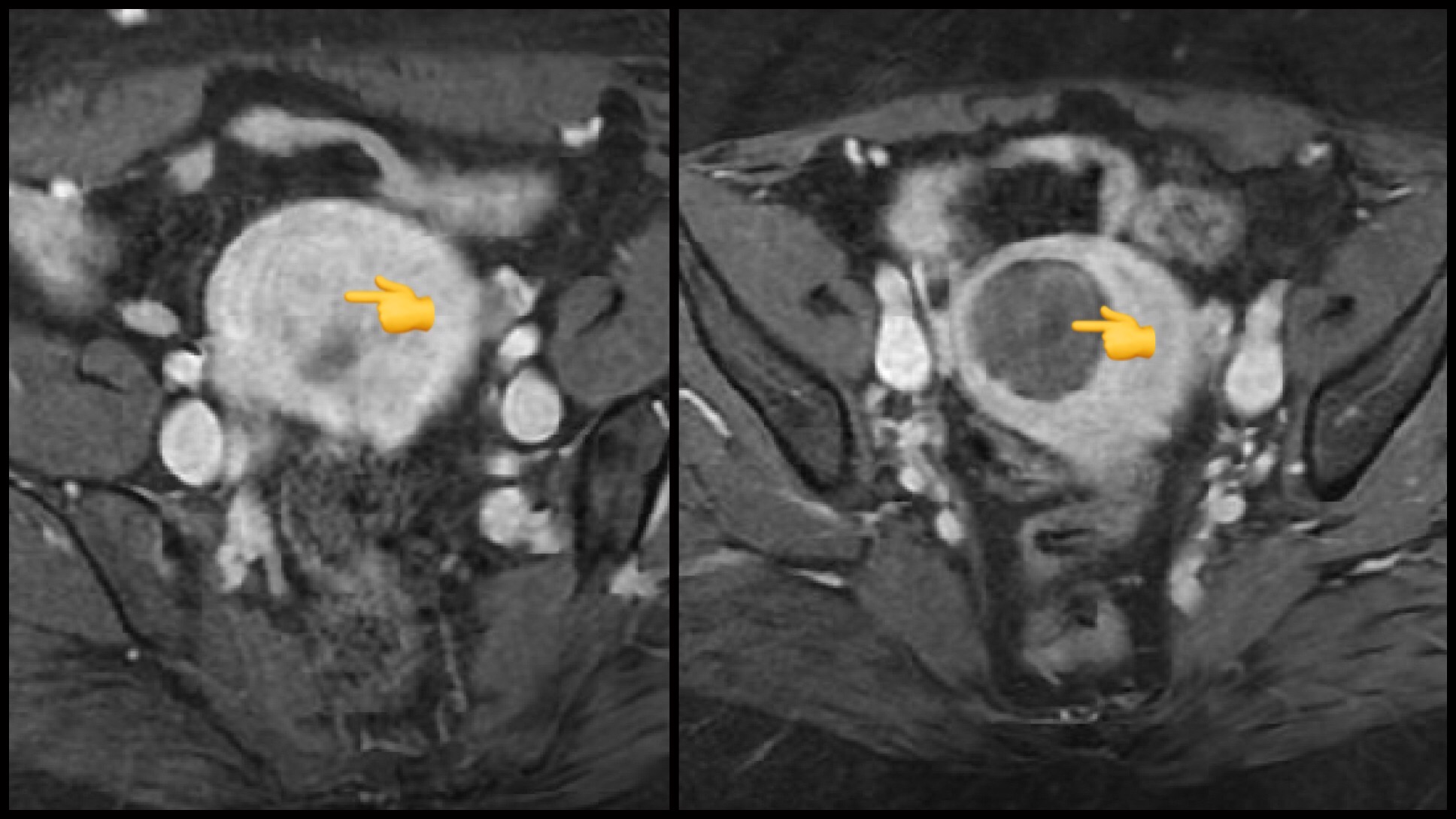 Uterine Fibroids Xray