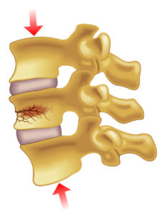 Wedge compression fracture