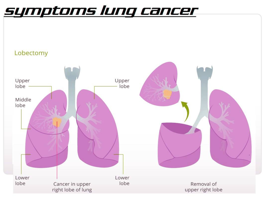 Lung Cancer Types Chart