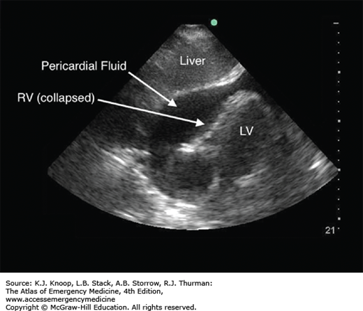 EMERGENCY ULTRASOUND | Anesthesia Key