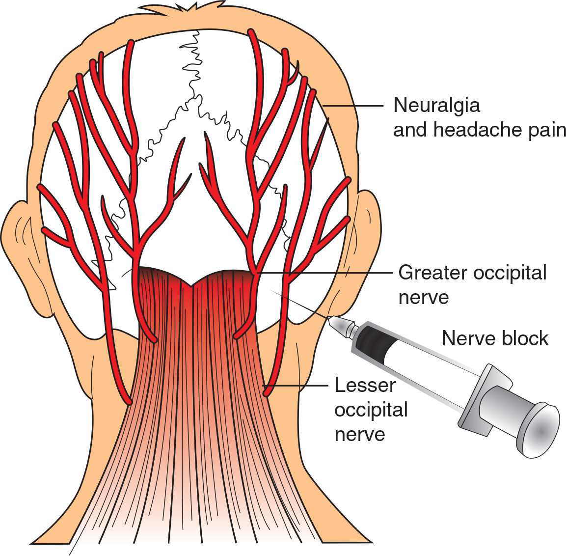 Occipital Nerve Stimulator Occipital Occipital Neuralgia Nerve Anatomy ...