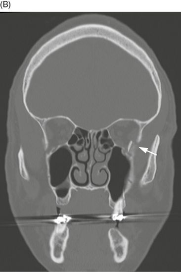 Maxillary Sinus Fracture