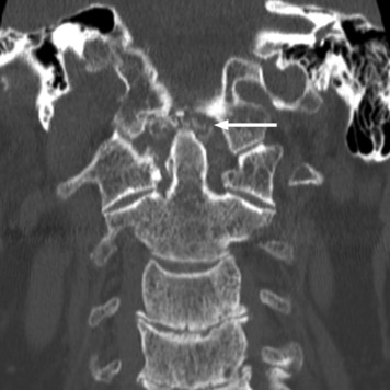 Elderly Male With Neck Stiffness and Fever | Anesthesia Key