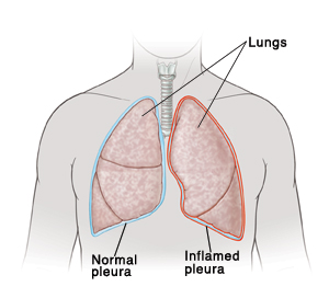 Pleurisy | Saint Luke's Health System