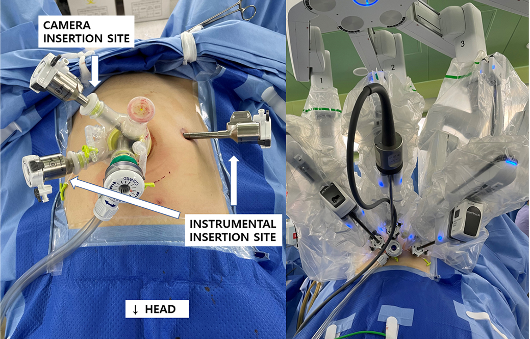 Referenzen Diskretion Das Layout robotic laparoscopic myomectomy Sinn ...