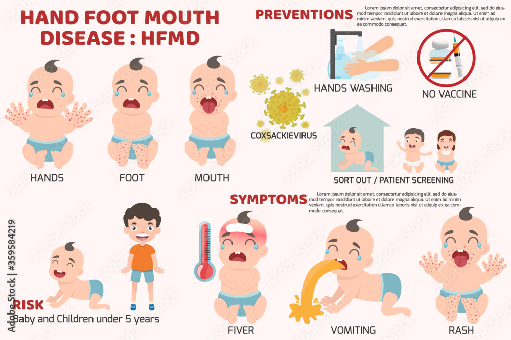 HFMD children infected. Poster detail of Hand-foot-mouth disease Infographics with symptoms prevention and treatment. cartoon health concept vector illustration.