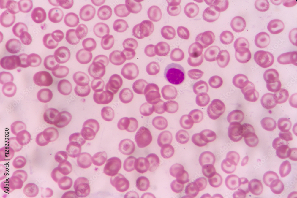 in Slide blood smear show target cell for complete blood count in ...