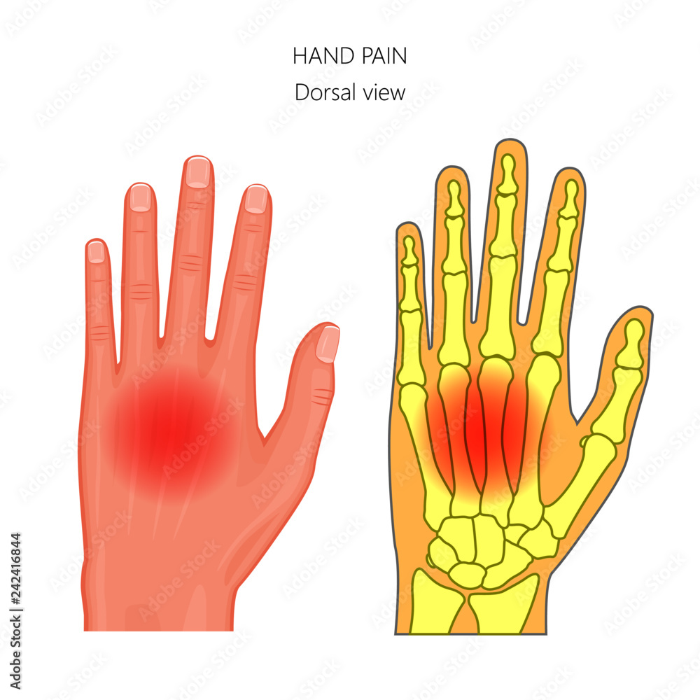 Wrist Hand Pain Diagram Reasonable Price | www.pinnaxis.com