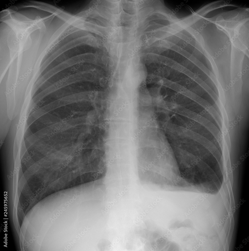 Foto de X-ray of the lungs: Hemothorax, rib fractures of the left. do ...