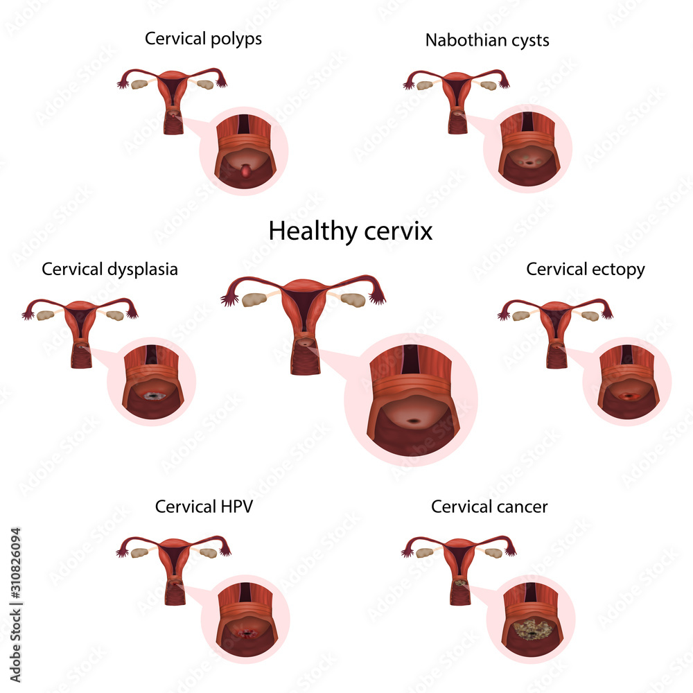 How does a Uterine Polyp impact your chances of having a Baby?