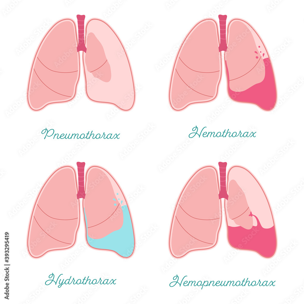 Picture Pneumothorax Hemothorax