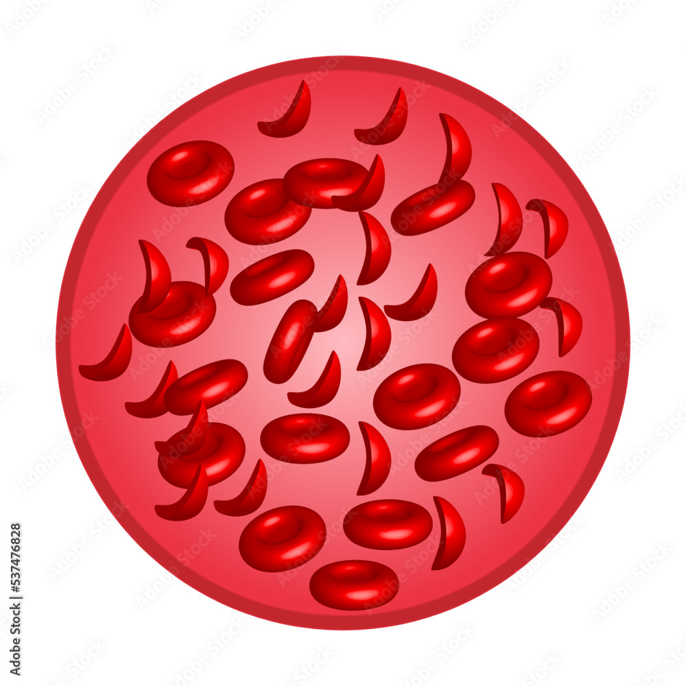 Fototapeta Anemia. Sickle cell anemia. sickle red blood cells. Sickle ...