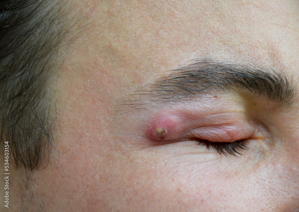 boil - a strong purulent abscess in a man near the eye. swelling from the infection has spread to the upper eyelid