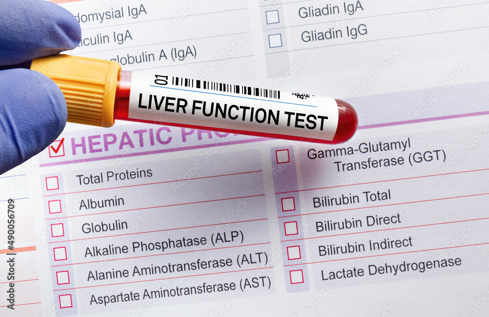 Blood tube test with requisition form for Liver Function Test LFT