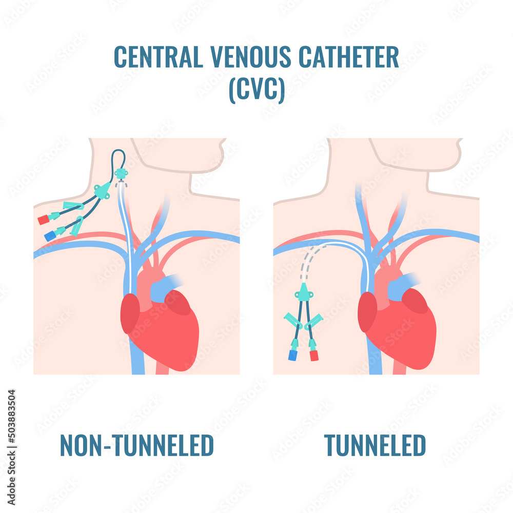 Different Types Of Tunneled Catheters at Crystal McBride blog