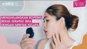 hilangkan-bopeng-dengan-minyak-kelapa.jpg