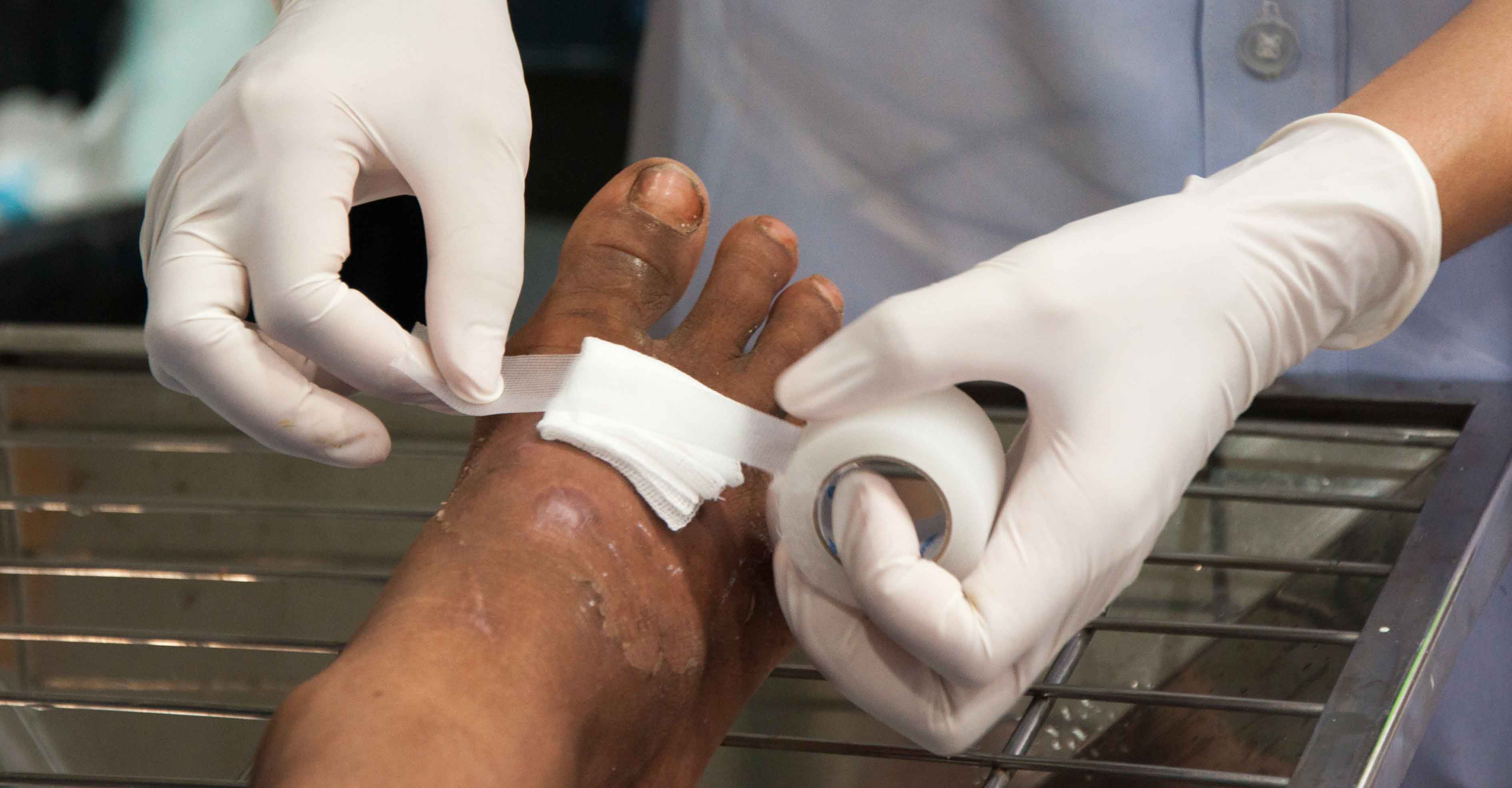 Demystifying Negative Pressure Wound Therapy: How It Works and Its Benefits