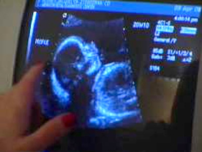 Ultrasound scan