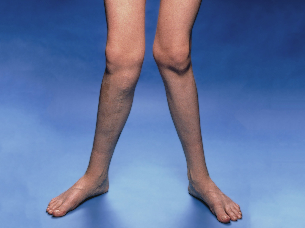 legs with knees that bend inwards slightly towards each other