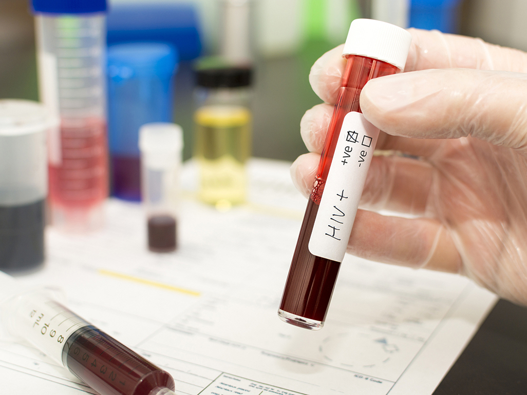 blood sample in a test tube, with hiv positive text written on a marker